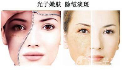 光子嫩膚如何護(hù)理？光子嫩膚的注意事項(xiàng)