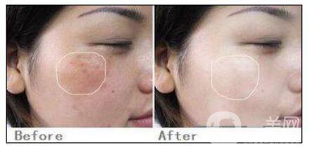 c6激光祛斑多少錢一次？c6激光祛斑價格詳解