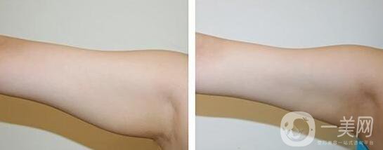 上臂吸脂減肥術(shù)要多少錢？手臂吸脂價格多少？