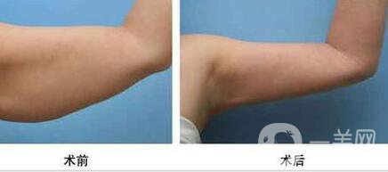 上臂吸脂減肥術(shù)要多少錢？手臂吸脂價格多少？