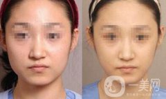 去頰脂墊要多少錢？去頰脂墊價格詳解