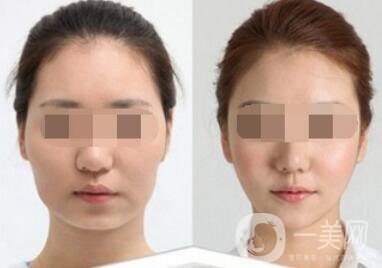 去頰脂墊要多少錢(qián)？去頰脂墊價(jià)格詳解