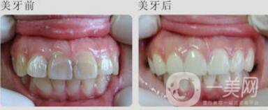 四環(huán)素牙怎么變白？四環(huán)素牙怎么辦？