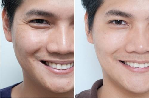 去魚尾紋的方法有哪些？玻尿酸去魚尾紋怎么樣？