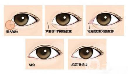 韓式開眼角多少錢？價格很貴嗎？