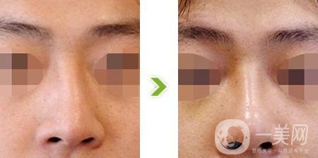 歪鼻矯正費用大概是多少？價格影響因素有哪些？