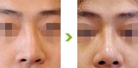 歪鼻矯正費(fèi)用大概是多少？價(jià)格影響因素有哪些？