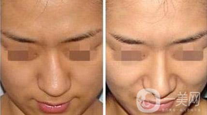 烤瓷牙有哪些種類？多久可以恢復？