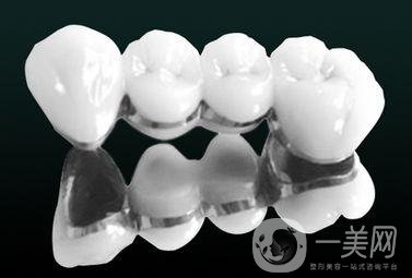 烤瓷牙有哪些種類？多久可以恢復？