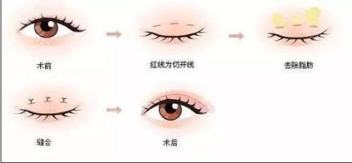 焊接雙眼皮是什么？手術后多久能好？