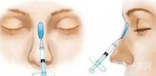 瑞蘭玻尿酸隆鼻價(jià)格需要多少?所需費(fèi)用詳解