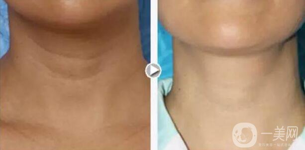 有頸紋怎么辦？去頸紋什么方法好？