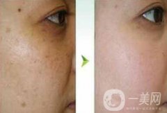 去蝴蝶斑用什么方法好？蝴蝶斑調(diào)節(jié)方法詳細介紹