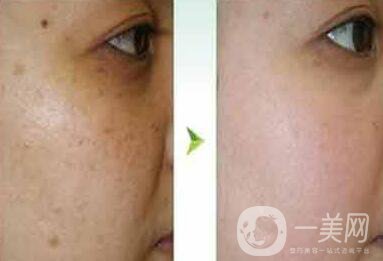 去蝴蝶斑用什么方法好？蝴蝶斑調(diào)節(jié)方法詳細(xì)介紹