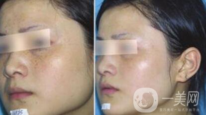 去蝴蝶斑用什么方法好？蝴蝶斑調(diào)節(jié)方法詳細(xì)介紹