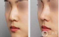 駝峰鼻矯正需要多少錢？駝峰鼻矯正費用詳解