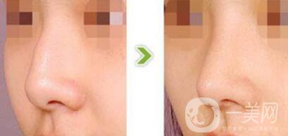 駝峰鼻矯正需要多少錢？駝峰鼻矯正費(fèi)用詳解
