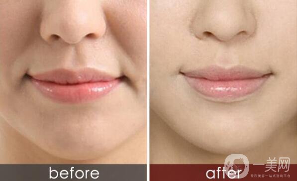 怎么除去法令紋？什么方法可以去法令紋？