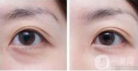 自體脂肪填充眼眶注意事項(xiàng)主要有哪些？