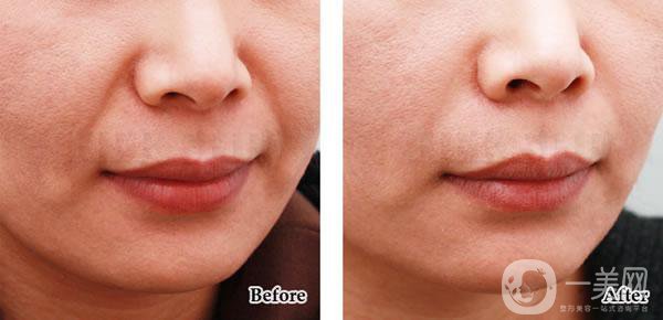 法令紋怎樣消除*果*好？該怎么樣做？