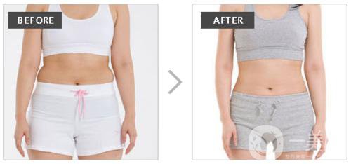 等離子激光溶脂價格是多少？于哪些因素有關？