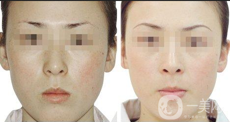 黑臉娃娃的副作用有哪些？怎樣可以減少副作用？