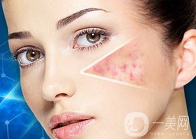 像素激光去痘坑*果怎么樣？怎樣很好的調(diào)節(jié)*果？