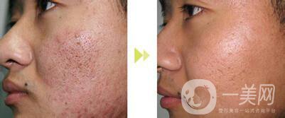 像素激光去痘坑*果怎么樣？怎樣很好的調(diào)節(jié)*果？