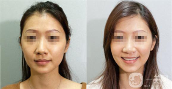 做黑臉娃娃的副作用有哪些？可以避免嗎？