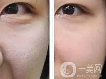 果酸換膚后注意事項(xiàng)盤點(diǎn)大揭秘，該怎么做？