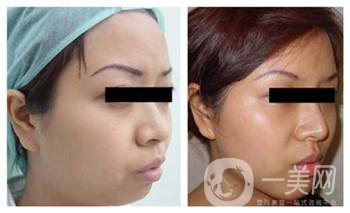 墊下巴一般用什么材料好？?jī)r(jià)格貴嗎？