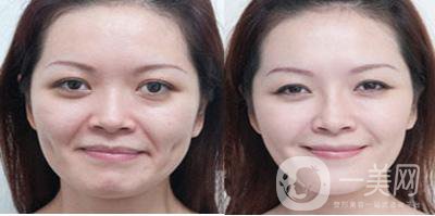 怎樣去鼻唇溝？哪些方法比較好？