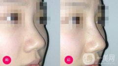 隆鼻什么材料好?？隆鼻的材料有哪幾種？