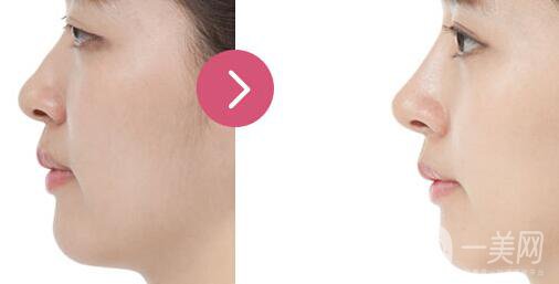 隆鼻什么材料好?？隆鼻的材料有哪幾種？