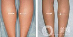 打注射瘦腿*果嗎？注射注射瘦腿作用怎么樣？