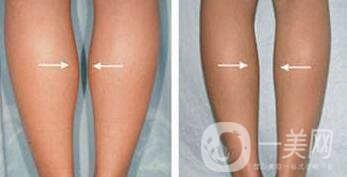 打**果嗎？注射*作用怎么樣？