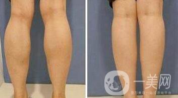 打**果嗎？注射*作用怎么樣？