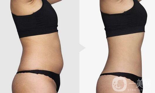南京吸脂減肥的價(jià)格是多少？吸脂減肥大概多少錢？