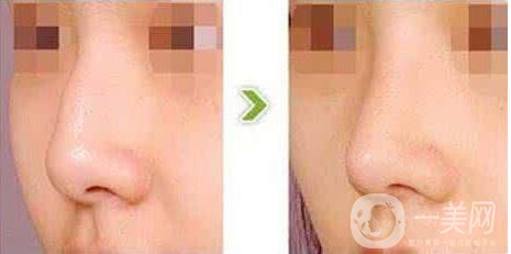 駝峰鼻,多少錢,費(fèi)用詳解