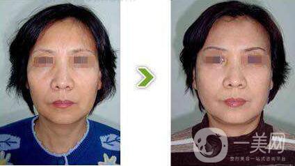 光子嫩膚,多少錢