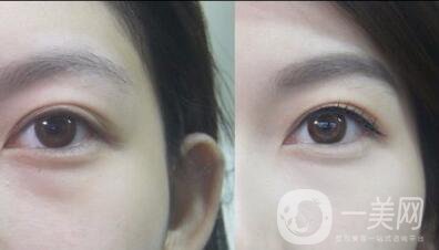 超聲去眼袋,多少錢