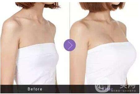 成都妙桃假體豐胸價(jià)格需要多少錢