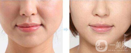 有法令紋怎么辦 法令紋如何去除