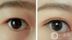 韓式三點(diǎn)雙眼皮是埋線還是割？手術(shù)果怎么樣