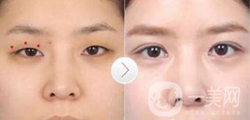 韓式三點雙眼皮是埋線還是割？手術*果怎么樣