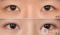 高分子埋線是*的嗎？可以維持幾年？