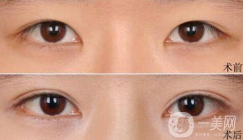 高分子埋線是*的嗎？可以維持幾年？