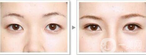 高分子埋線是*的嗎？可以維持幾年？