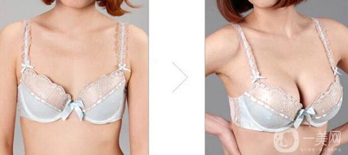 水滴型假體隆胸怎么樣？隆胸風(fēng)險(xiǎn)高嗎？