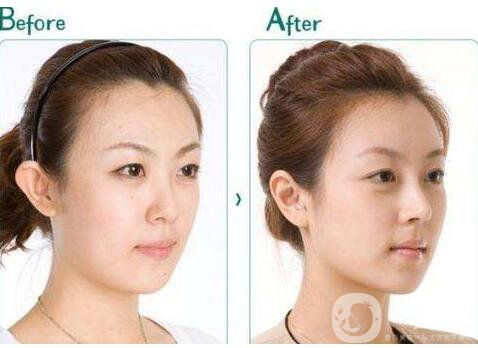 自體軟骨隆鼻尖,價(jià)格